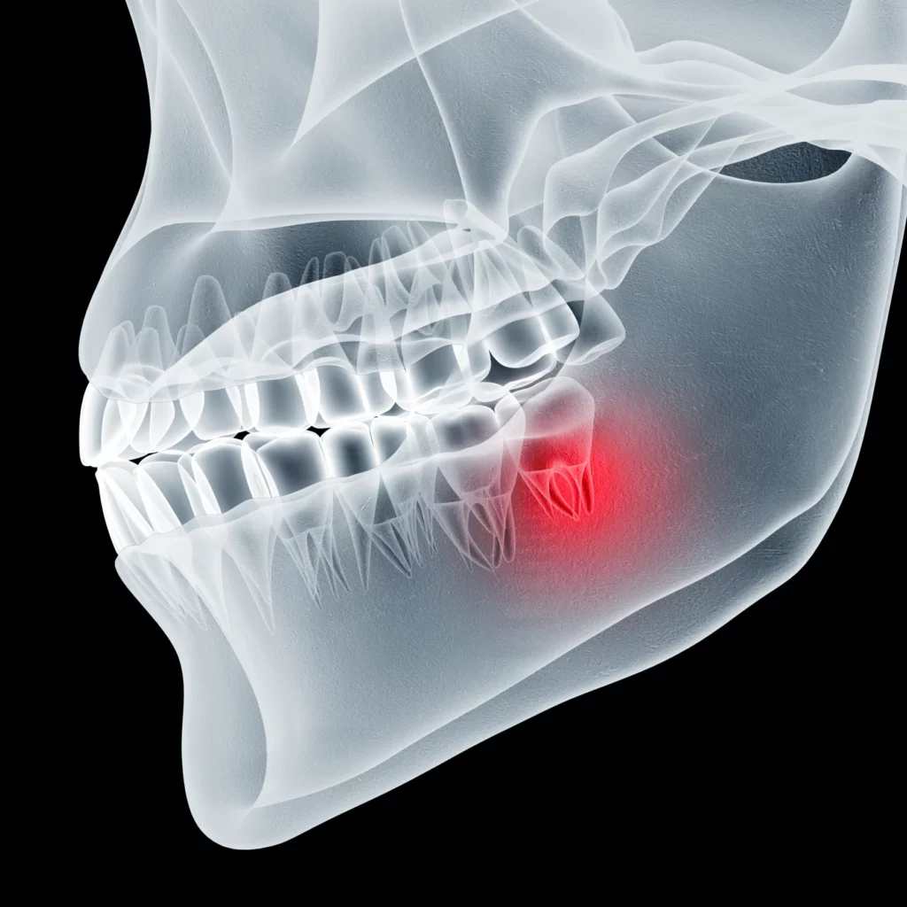 wisdom teeth removal in Punta Gorda, FL