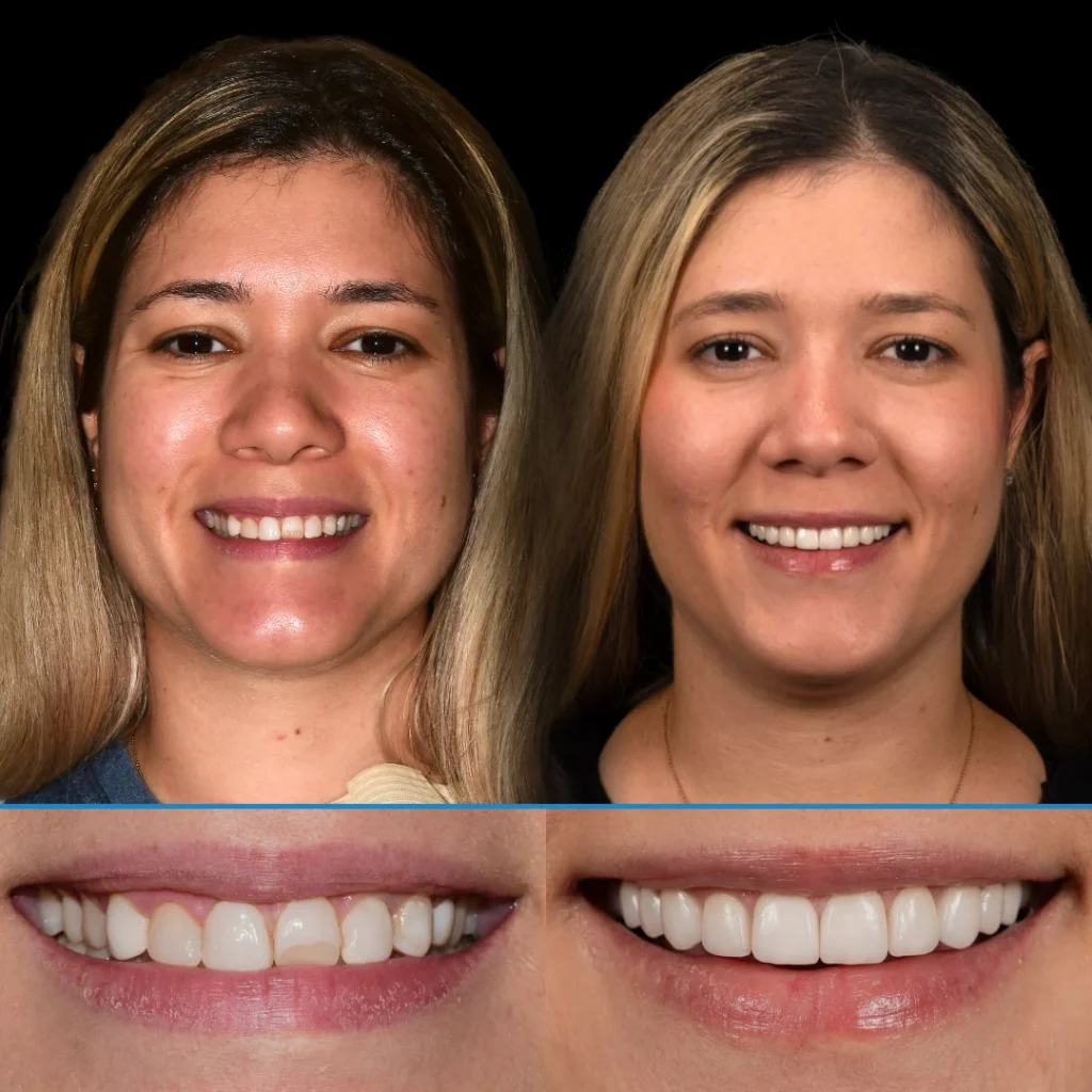 Veneers before and after photo in Punta Gorda, FL at Dolecki Advanced Dentistry & Implants