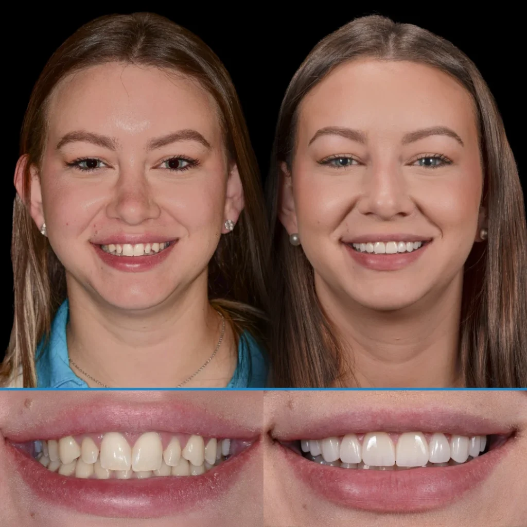 Veneers before and after photo in Punta Gorda, FL at Dolecki Advanced Dentistry & Implants