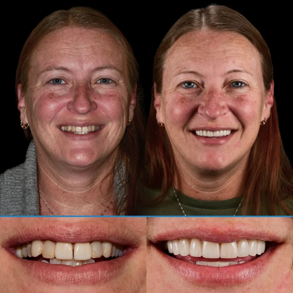 Veneers before and after photo in Punta Gorda, FL at Dolecki Advanced Dentistry & Implants