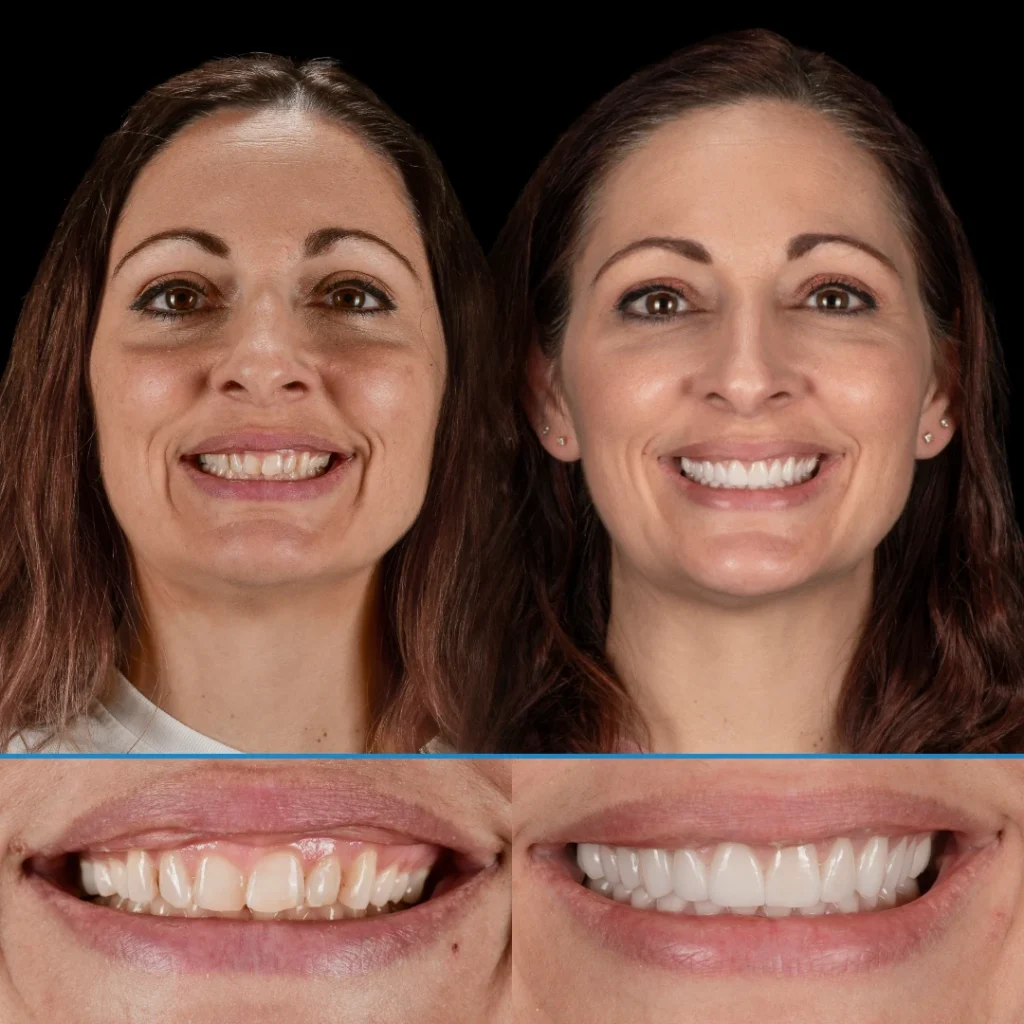 Veneers before and after photo in Punta Gorda, FL at Dolecki Advanced Dentistry & Implants